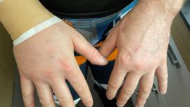 Als wäre die Dakar nicht eh schon hart genug, kämpft sich Walkner trotz verletzter Hand weiter durch!